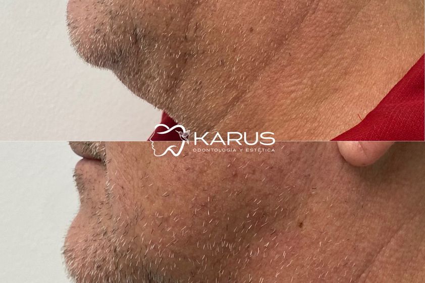 Armonización facial antes y después - 878289