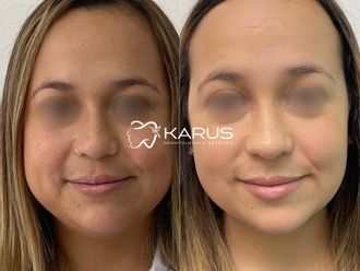 Bolas de Bichat antes y después - 878290