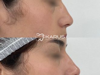 Ácido hialurónico antes y después - 878291