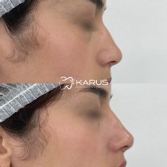 Rinomodelación -Clínica Karus