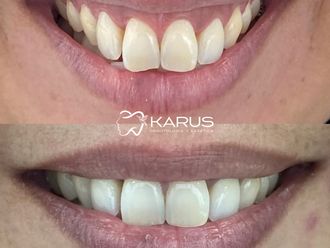 Bótox antes y después - 878292