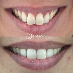 Tratamiento Sonrisa Gingival -Clínica Karus