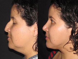 Rinoplastia Dr Rafael Pinto Cirugia Plastica