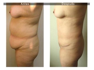 Abdominoplastia
