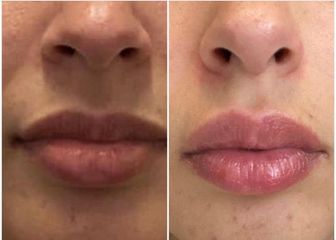 Aumento de labios - Integral Esthetic