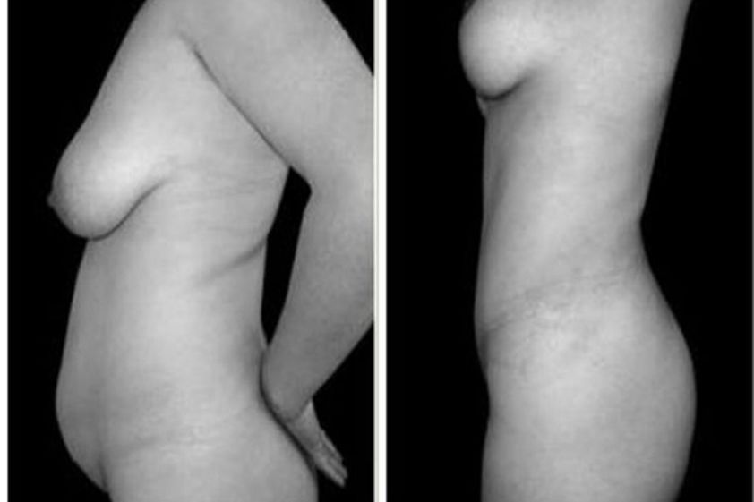 Mastopexia antes y después - 487380