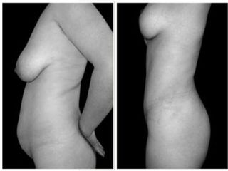 Mastopexia y abdominoplastía