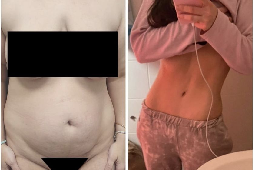 Abdominoplastía antes y después - 854678
