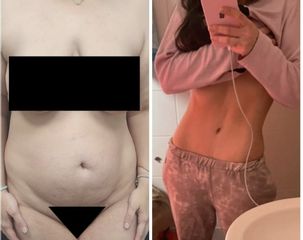 Abdominoplastia - Corpore Clinic