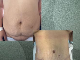 Abdominoplastía antes y después - 880876