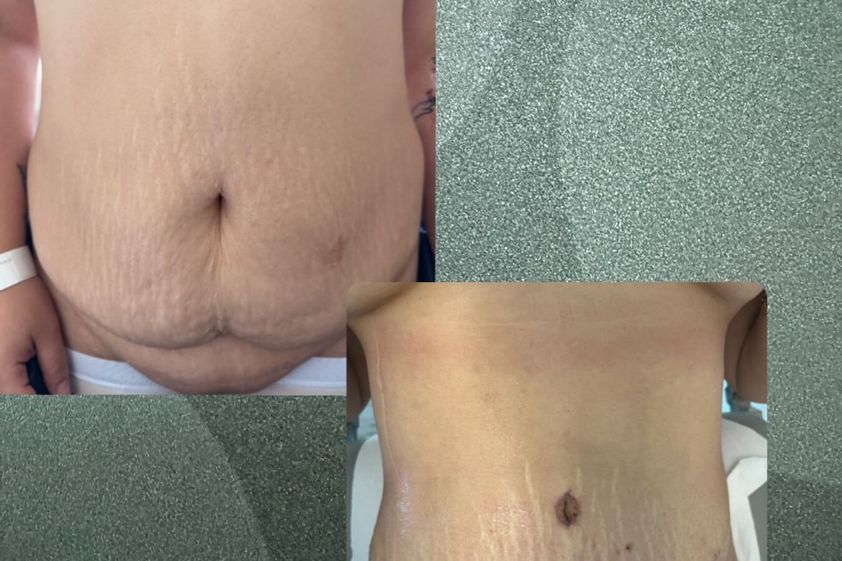 Abdominoplastía antes y después - 880876