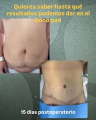 Abdominoplastia - Dr Aref Ayaach Rodriguez