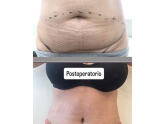 Abdominoplastía antes y después - 880877