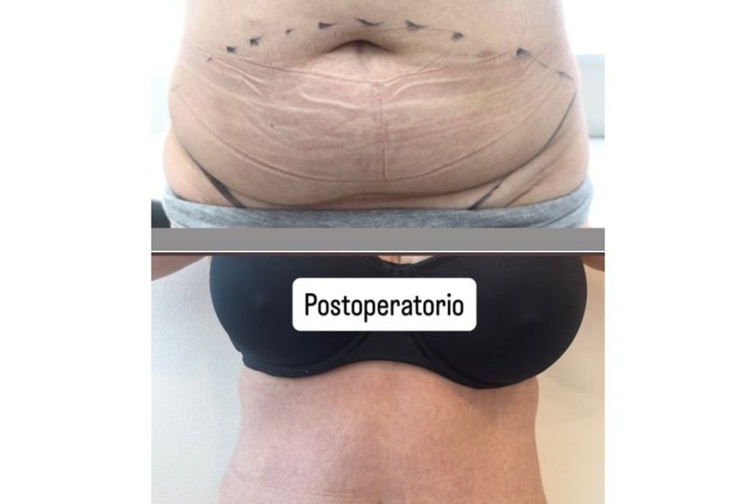 Abdominoplastía antes y después - 880877