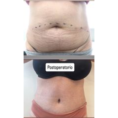 Abdominoplastia - Dr Aref Ayaach Rodriguez