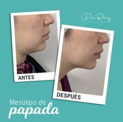 Antes y después de tres sesiones de mesolipo de papada