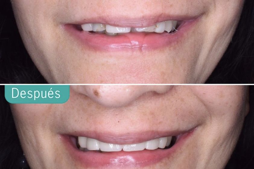 Carillas dentales antes y después - 810886