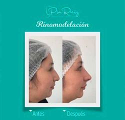 Rinomodelación - Dra. Pia Ruiz