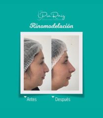 Rinomodelación - Clínica Visage