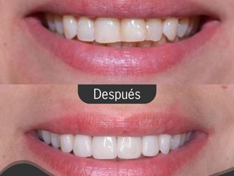 Blanquear dientes antes y después - 861565