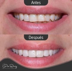 Blanquear dientes - Clínica Visage