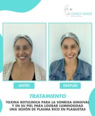 Toxina botulínica - Clínica Visage