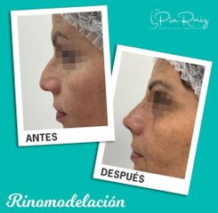 Rinomodelación - Clínica Visage