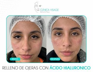 Tratamiento de ojeras - Clínica Visage