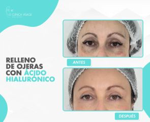 Tratamiento de ojeras - Clínica Visage
