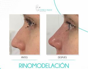 Rinomodelación - Clínica Visage