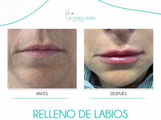 Aumento de labios - Clínica Visage