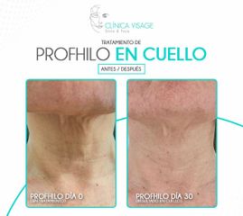 Profhilo en cuello - Clínica Visage