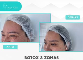 Bótox - Clínica Visage