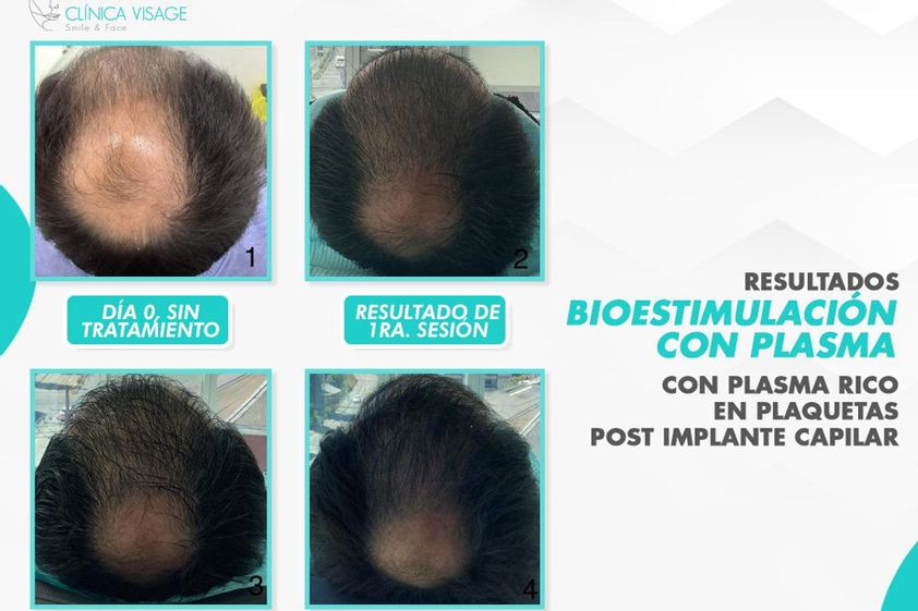 Plasma rico en plaquetas antes y después - 863429