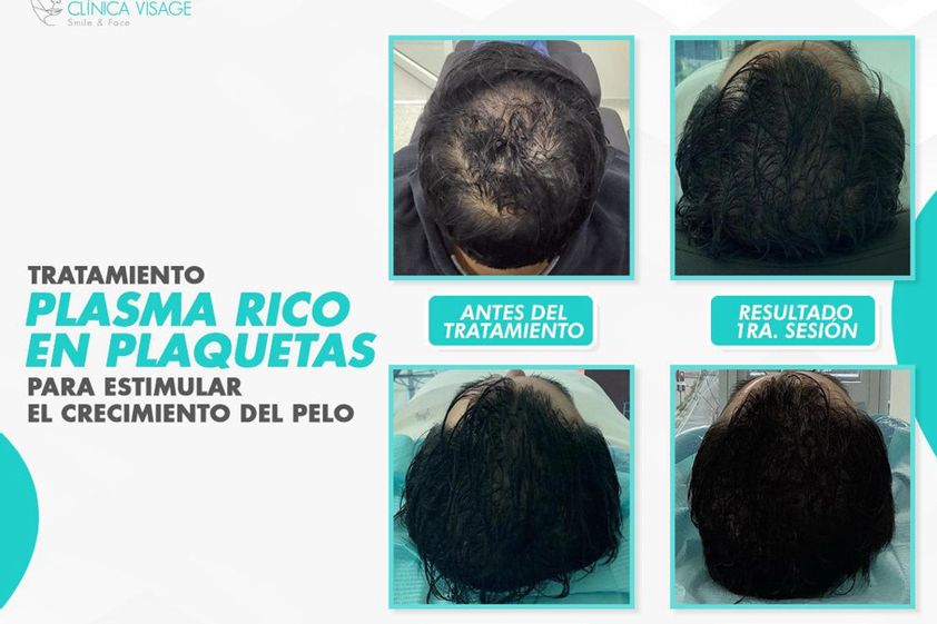 Plasma rico en plaquetas antes y después - 863432