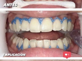 Blanquear dientes - 863530