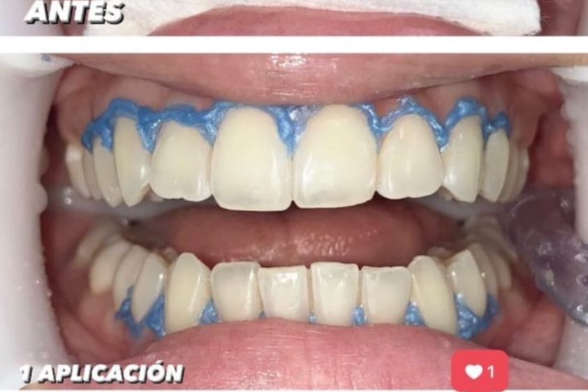 Blanquear dientes antes y después - 863530