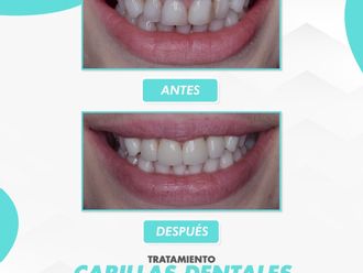 Carillas dentales - 863531