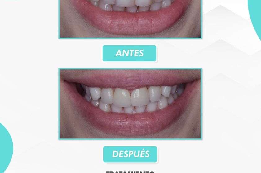Carillas dentales antes y después - 863531