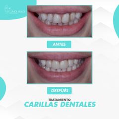Carillas Dentales - Clinica Visage