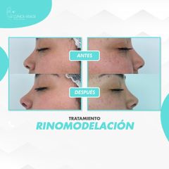 Rinomodelación - Clinica Visage