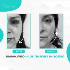 Hilos Tensores - Clinica Visage