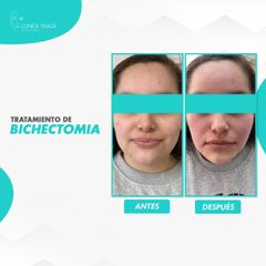 Bichectomia - Clinica Visage