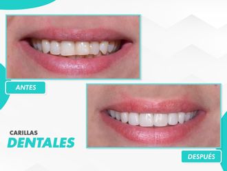 Carillas dentales - 866116