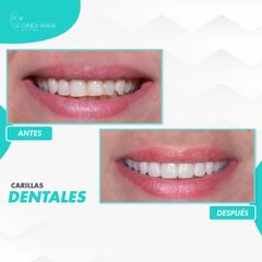 Carillas Dentales - Clinica Visage