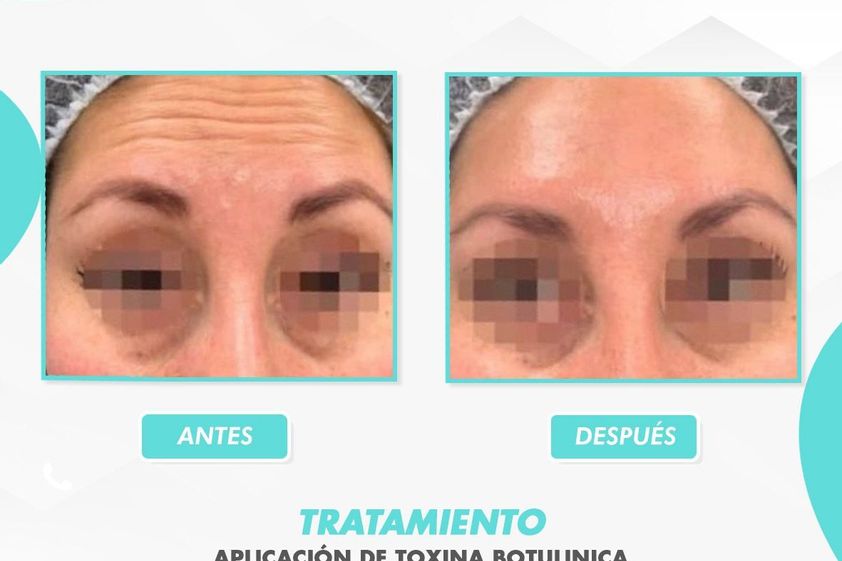 Bótox antes y después - 866117