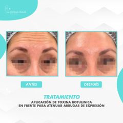 Botox - Clinica Visage