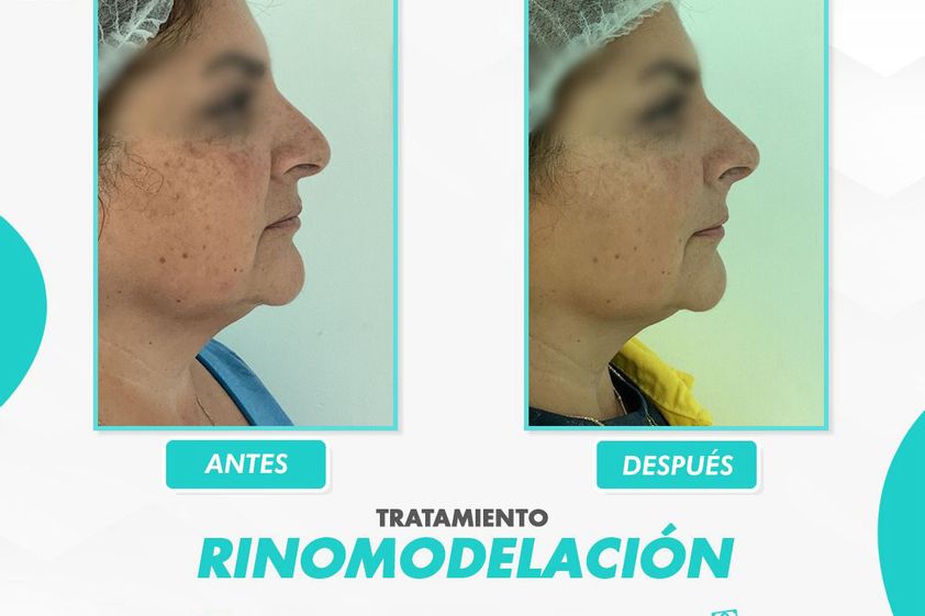 Rinomodelación antes y después - 866119