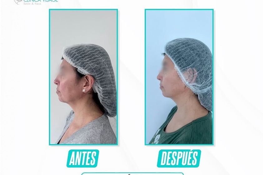Rejuvenecimiento facial antes y después - 873765