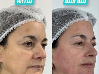 Armonización facial antes y después - 878187